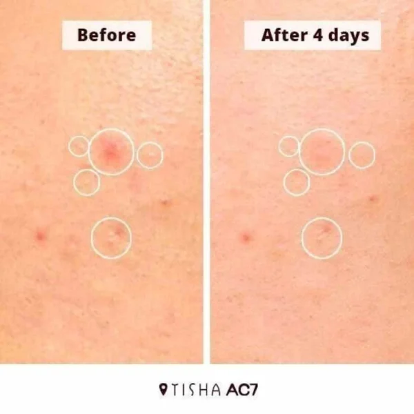 tisha-ac7-acne-spot-serum-15ml-pic-5
